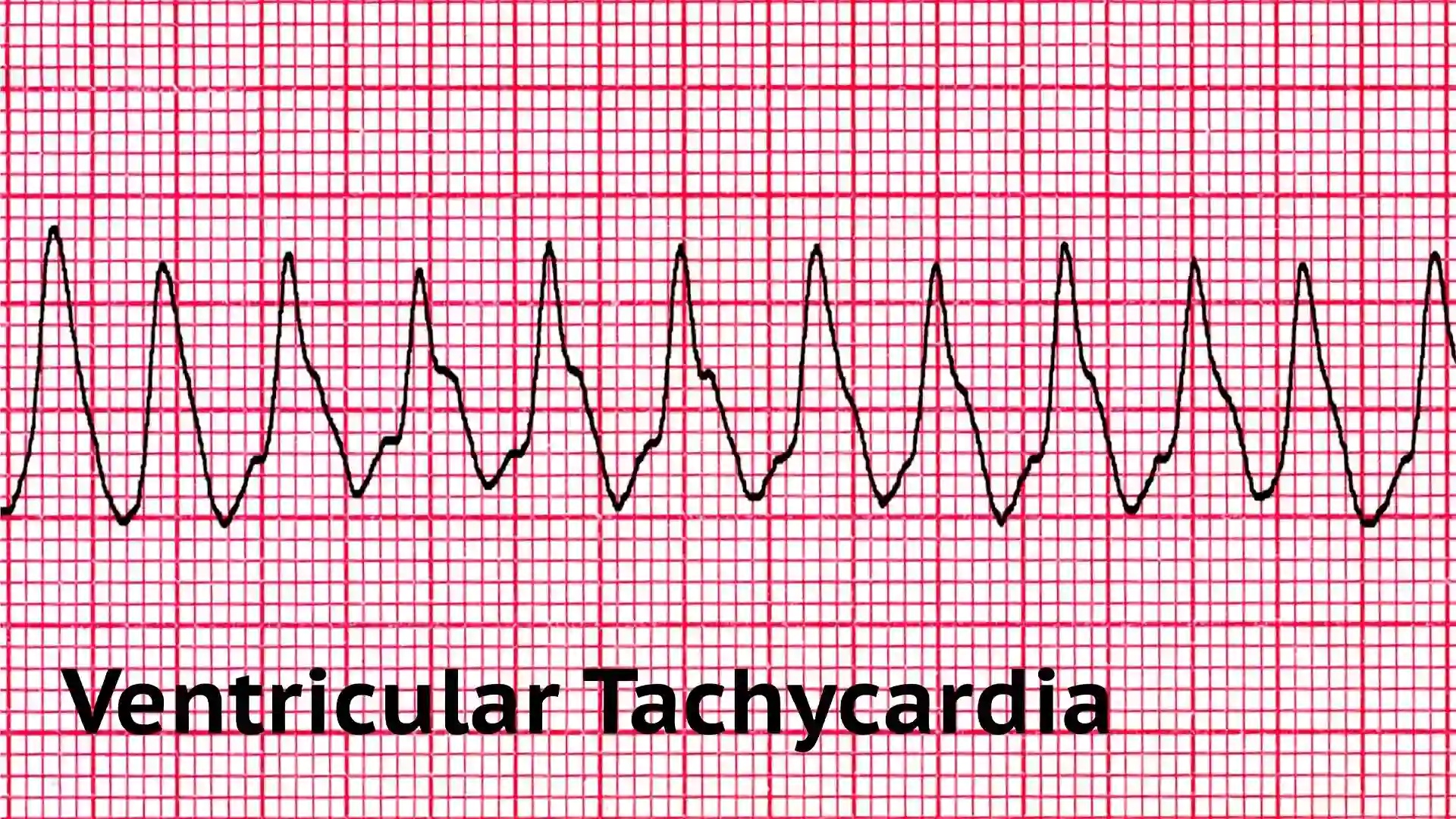 Ventricular Tachycardia (V-Tach)